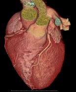 Pubblicato documento sulle cardiopatie congenite scoperte nell’anziano 